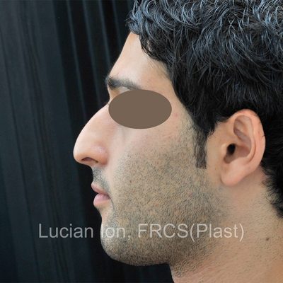 Before reduction rhinoplasty, case 2, profile view