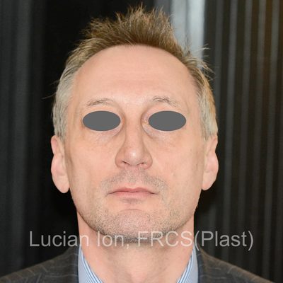 After reduction rhinoplasty, case 3, front view