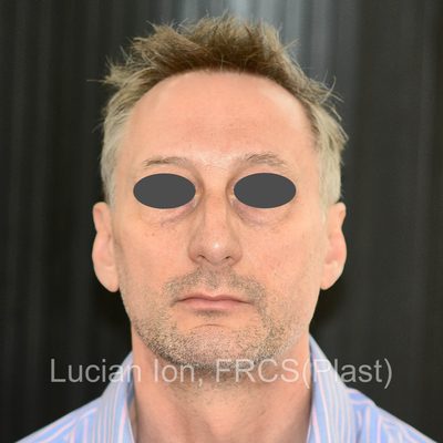 Before reduction rhinoplasty, case 3, front view