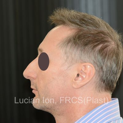 Before reduction rhinoplasty, case 3, profile view