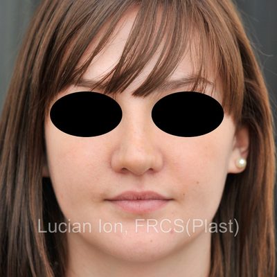 After reduction rhinoplasty, case 4, front view