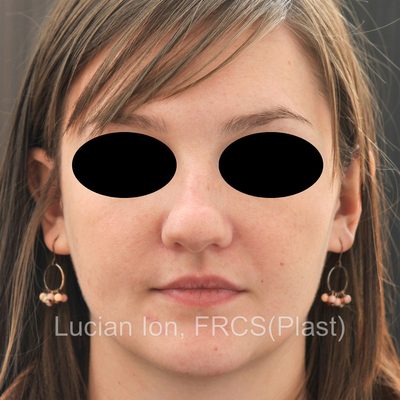 Before reduction rhinoplasty, case 4, front view