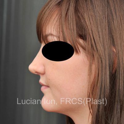 After reduction rhinoplasty, case 4, profile view