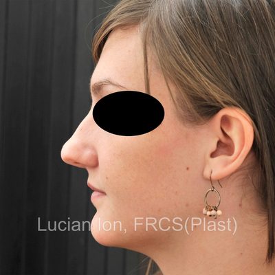 Before reduction rhinoplasty, case 4, profile view
