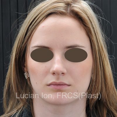 Before reduction rhinoplasty, case 5, front view