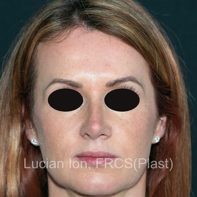 After reduction rhinoplasty, case 6, front view