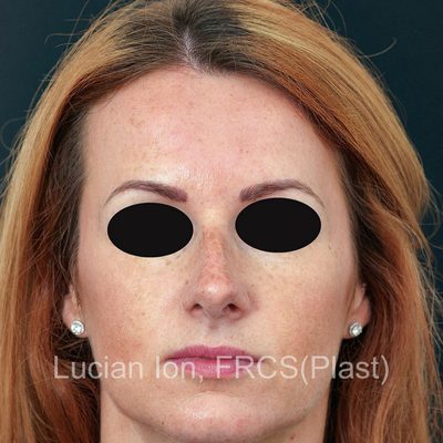 Before reduction rhinoplasty, case 6, front view