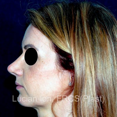 After reduction rhinoplasty, case 6, profile view