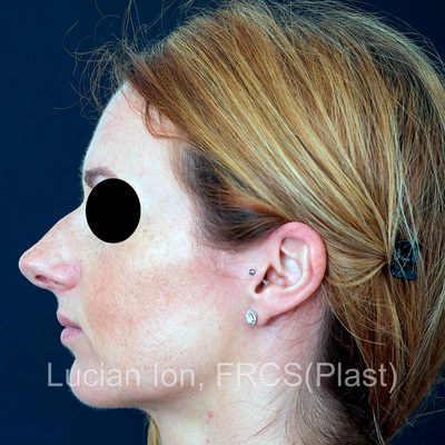 Before reduction rhinoplasty, case 6, profile view