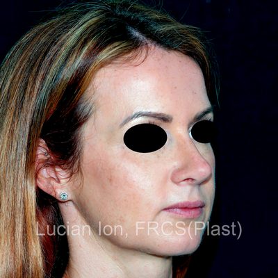 After reduction rhinoplasty, case 6, profile view