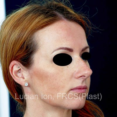 Before reduction rhinoplasty, case 6, profile view