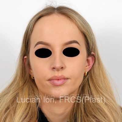 After reduction rhinoplasty, case 7, front view