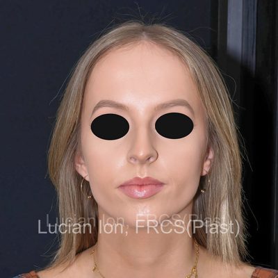 Before reduction rhinoplasty, case 7, front view
