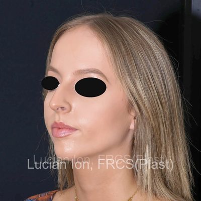 Before reduction rhinoplasty, case 7, oblique view