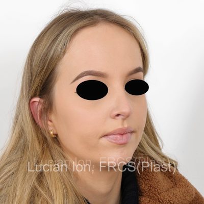 After reduction rhinoplasty, case 7, oblique view
