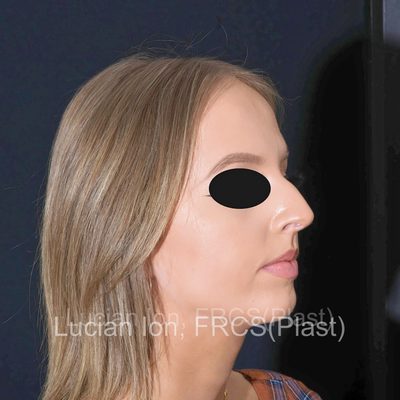 Before reduction rhinoplasty, case 7, oblique view