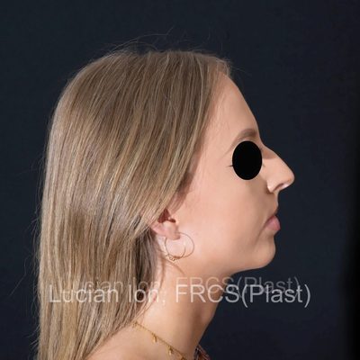 Before reduction rhinoplasty, case 7, profile view