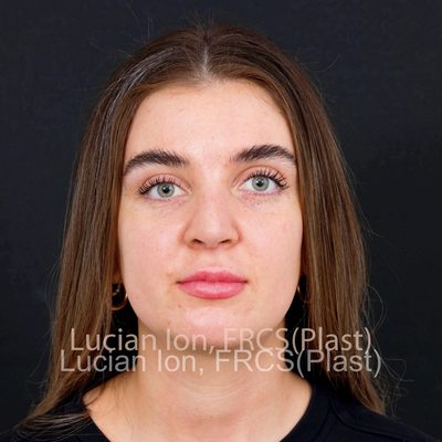 After reduction rhinoplasty, case 8, front view