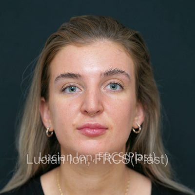 Before reduction rhinoplasty, case 8, front view