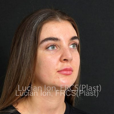 After reduction rhinoplasty, case 8, oblique view