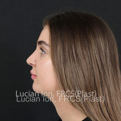 After reduction rhinoplasty, case 8, profile view