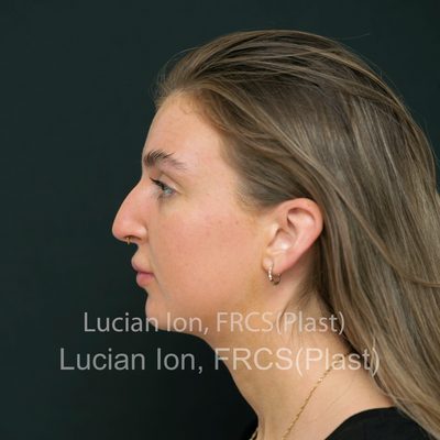 Before reduction rhinoplasty, case 8, profile view