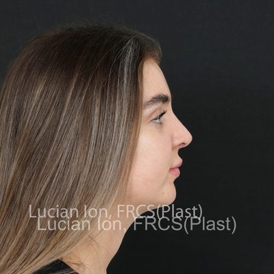 After reduction rhinoplasty, case 8, profile view