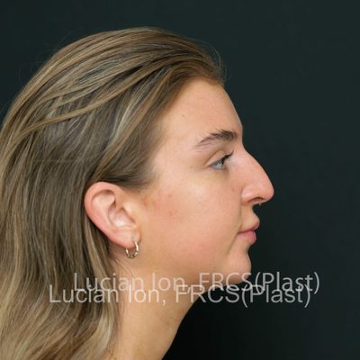 Before reduction rhinoplasty, case 8, profile view