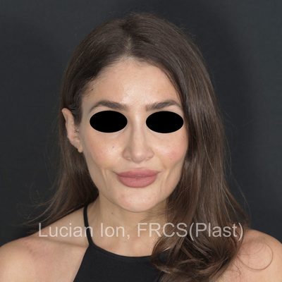 After reduction rhinoplasty, case 9, front view