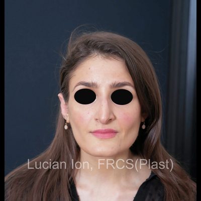 Before reduction rhinoplasty, case 9, front view