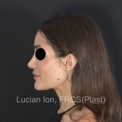 After reduction rhinoplasty, case 9, profile view