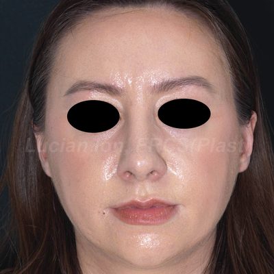 After reduction rhinoplasty, case 10, front view