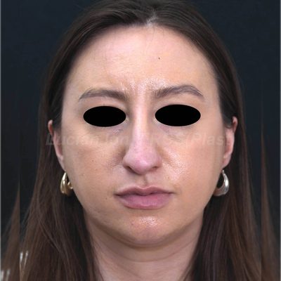 Before reduction rhinoplasty, case 10, front view