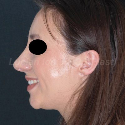 After reduction rhinoplasty, case 10, profile view