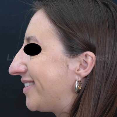 Before reduction rhinoplasty, case 10, profile view