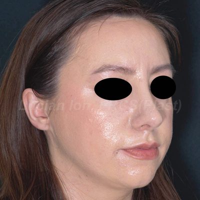 After reduction rhinoplasty, case 10, oblique view