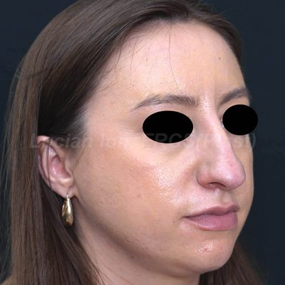 Before reduction rhinoplasty, case 10, oblique view