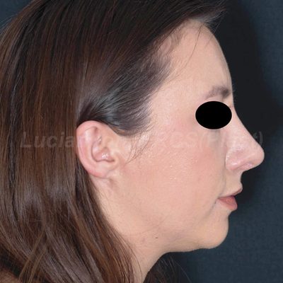 After reduction rhinoplasty, case 10, profile view