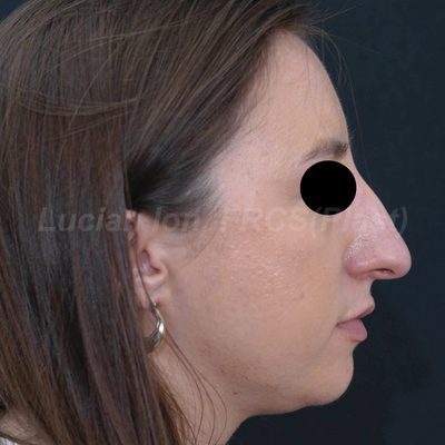 Before reduction rhinoplasty, case 10, profile view