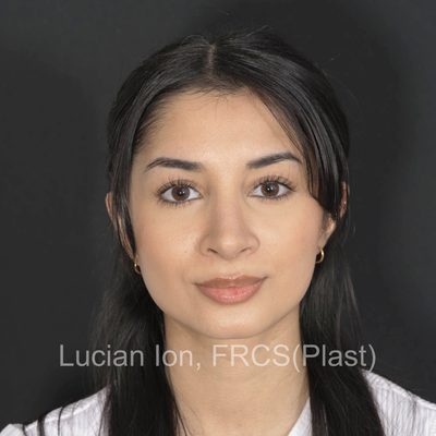 After reduction rhinoplasty, case 11, front view