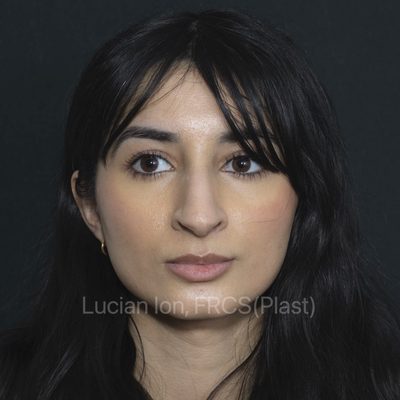 Before reduction rhinoplasty, case 11, front view