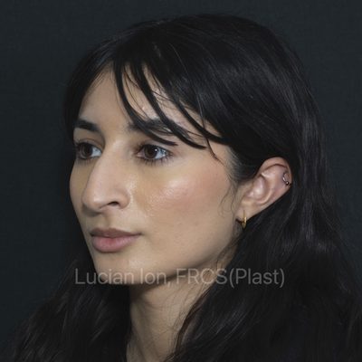 Before reduction rhinoplasty, case 11, oblique view