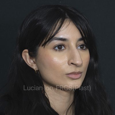 Before reduction rhinoplasty, case 11, oblique view