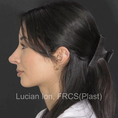 After reduction rhinoplasty, case 11, profile view