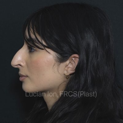 Before reduction rhinoplasty, case 11, profile view