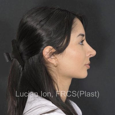 After reduction rhinoplasty, case 11, profile view