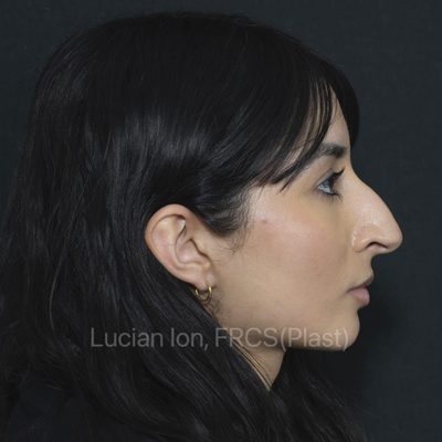 Before reduction rhinoplasty, case 11, profile view