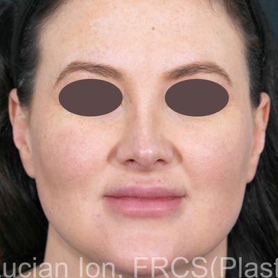After secondary rhinoplasty, case 1, front view