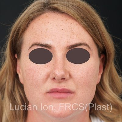 Before secondary rhinoplasty, case 1, front view
