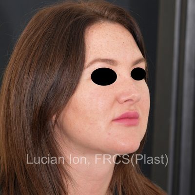 After secondary rhinoplasty, case 1, oblique view